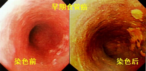 我院消化科染色内镜技术顺利通过专家组验收